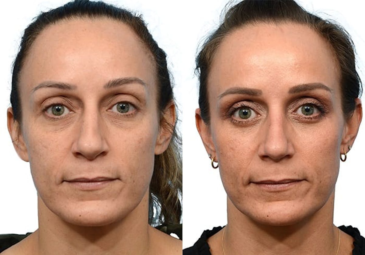 Blepharoplasty (Eyelid Surgery) Before & After Gallery - Patient 138587 - Image 1
