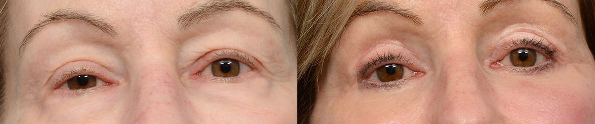 Blepharoplasty (Eyelid Surgery) Before & After Gallery - Patient 328319 - Image 1