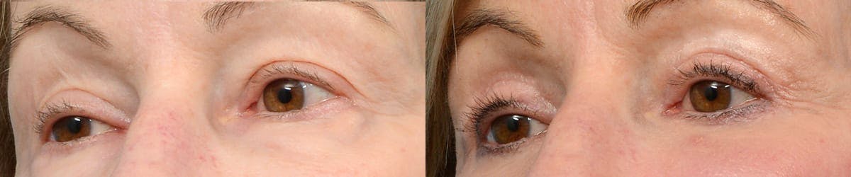 Blepharoplasty (Eyelid Surgery) Before & After Gallery - Patient 328319 - Image 2