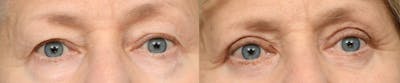Blepharoplasty (Eyelid Surgery) Before & After Gallery - Patient 199808 - Image 1