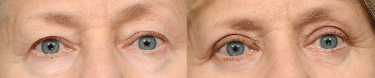 Blepharoplasty (Eyelid Surgery) Before & After Gallery - Patient 199808 - Image 1
