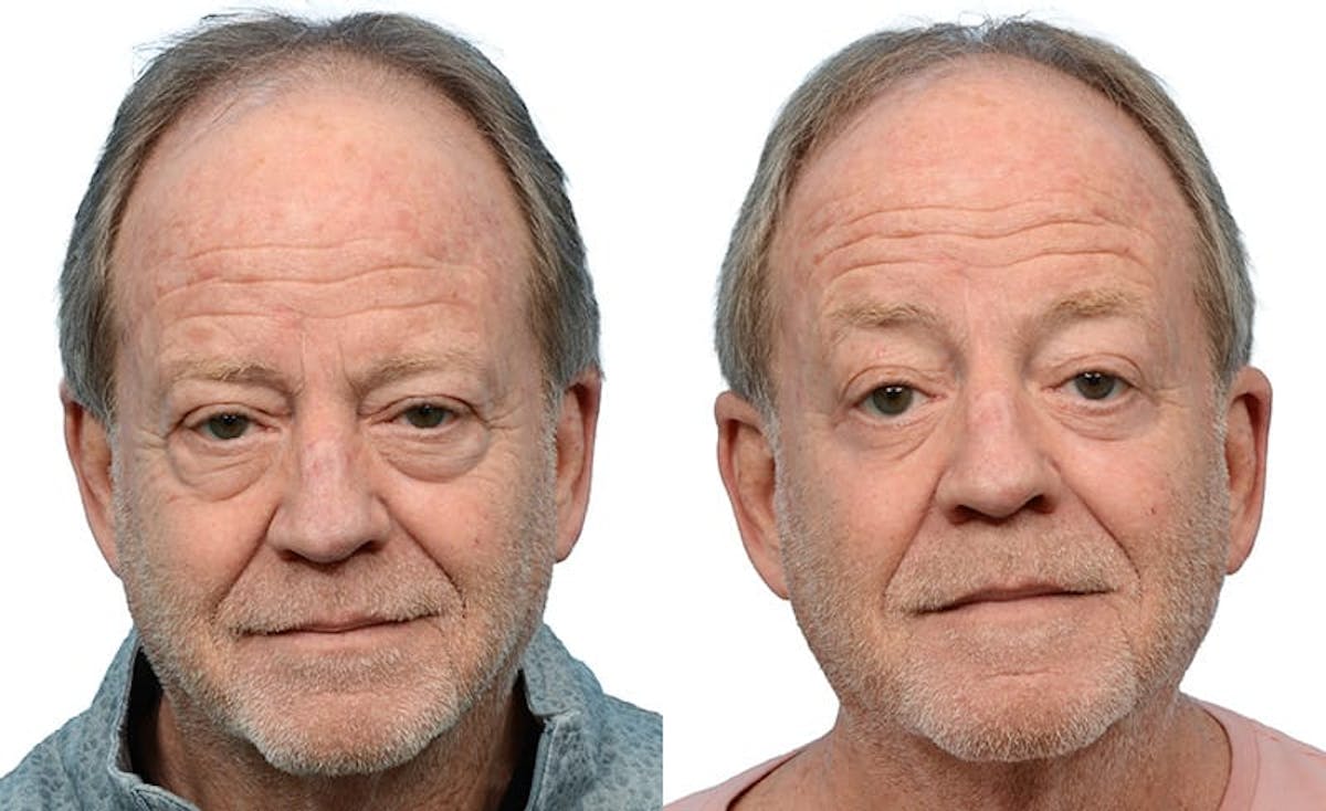 Blepharoplasty (Eyelid Surgery) Before & After Gallery - Patient 248608 - Image 1