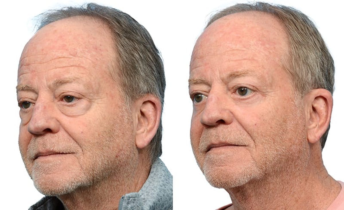 Blepharoplasty (Eyelid Surgery) Before & After Gallery - Patient 248608 - Image 3