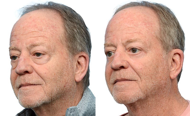 Blepharoplasty (Eyelid Surgery) Before & After Gallery - Patient 248608 - Image 3