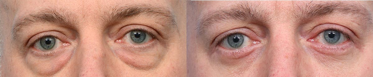 Blepharoplasty (Eyelid Surgery) Before & After Gallery - Patient 202042 - Image 1
