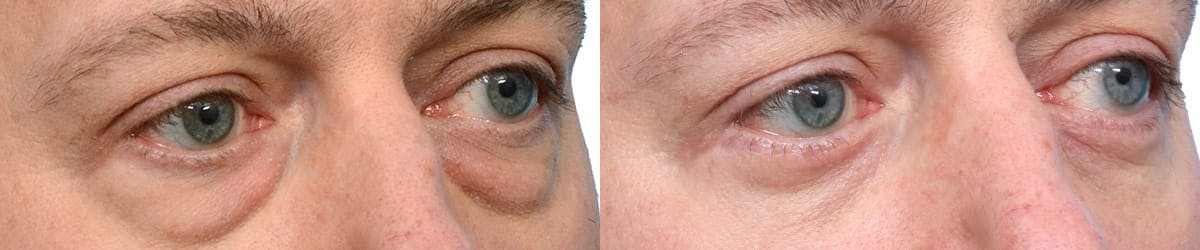 Blepharoplasty (Eyelid Surgery) Before & After Gallery - Patient 202042 - Image 2