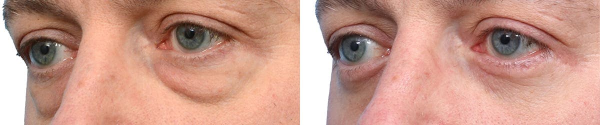 Blepharoplasty (Eyelid Surgery) Before & After Gallery - Patient 202042 - Image 3