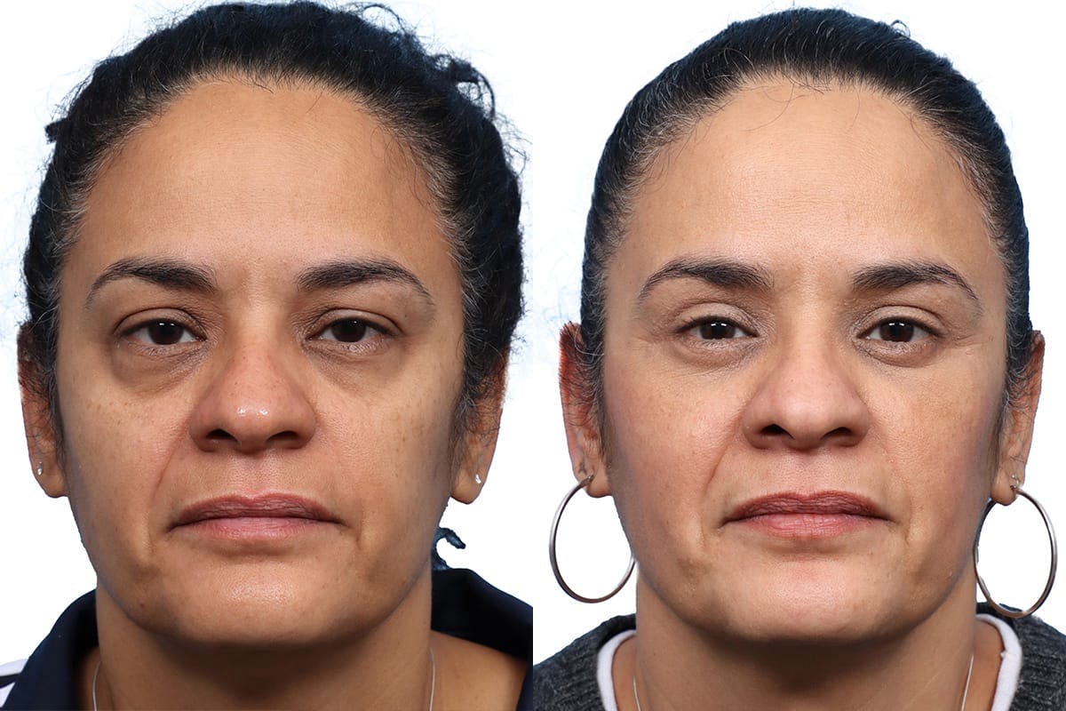 Blepharoplasty (Eyelid Surgery) Before & After Gallery - Patient 348083 - Image 1