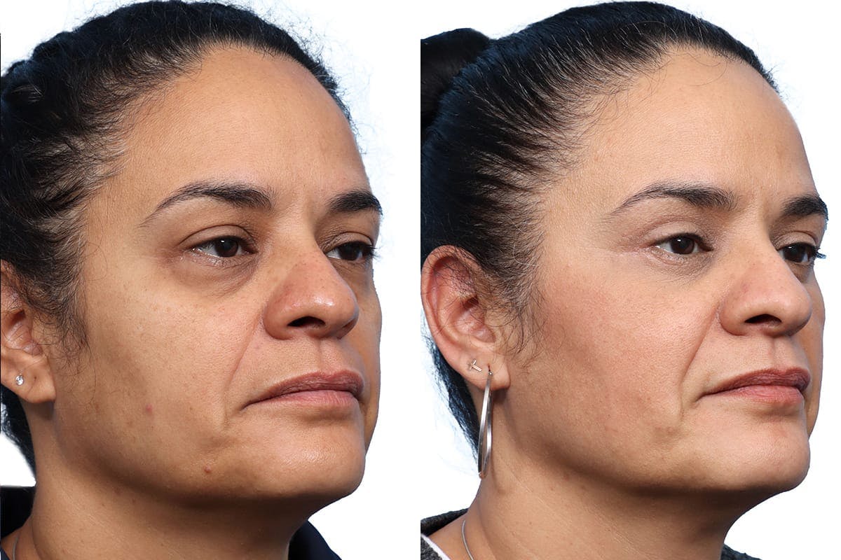 Blepharoplasty (Eyelid Surgery) Before & After Gallery - Patient 348083 - Image 3