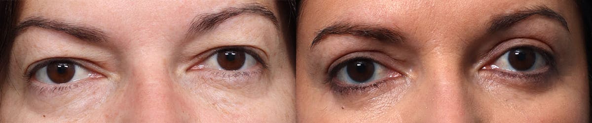 Blepharoplasty (Eyelid Surgery) Before & After Gallery - Patient 385727 - Image 1