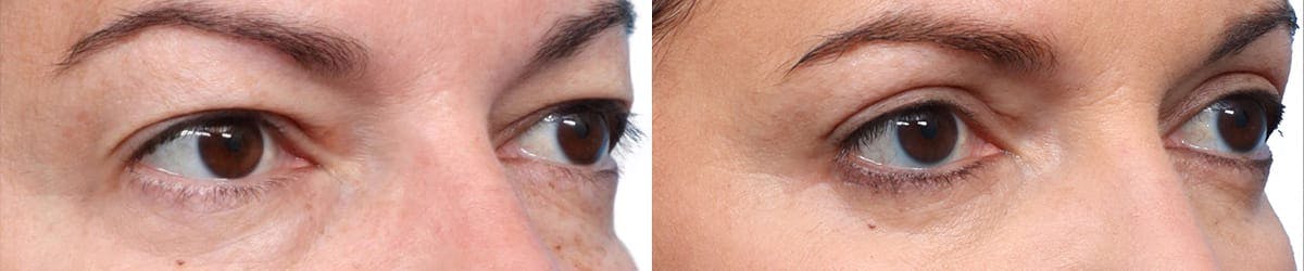 Blepharoplasty (Eyelid Surgery) Before & After Gallery - Patient 385727 - Image 2