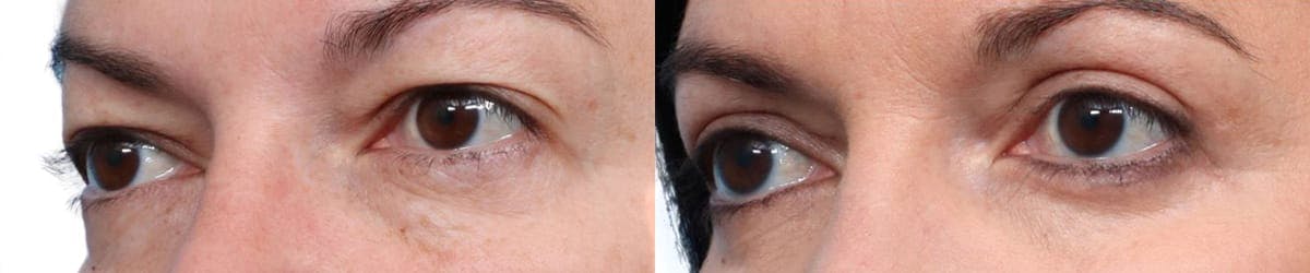 Blepharoplasty (Eyelid Surgery) Before & After Gallery - Patient 385727 - Image 3
