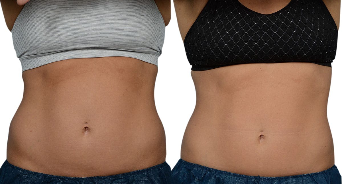 CoolSculpting® Before & After Gallery - Patient 236429 - Image 1