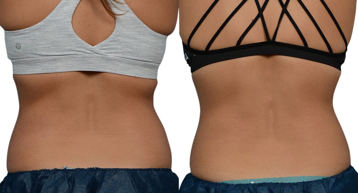 CoolSculpting® Before & After Gallery - Patient 236429 - Image 2
