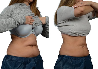 CoolSculpting® Before & After Gallery - Patient 970678 - Image 1