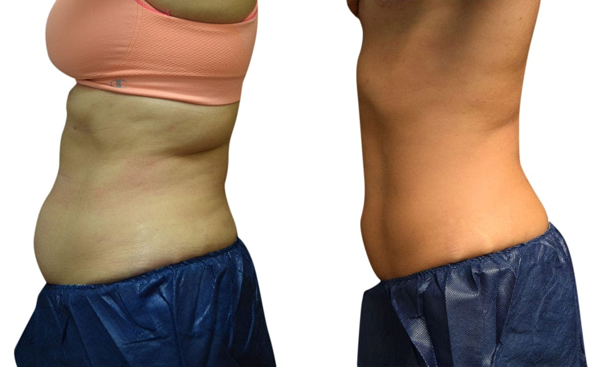 CoolSculpting® Before & After Gallery - Patient 351645 - Image 1