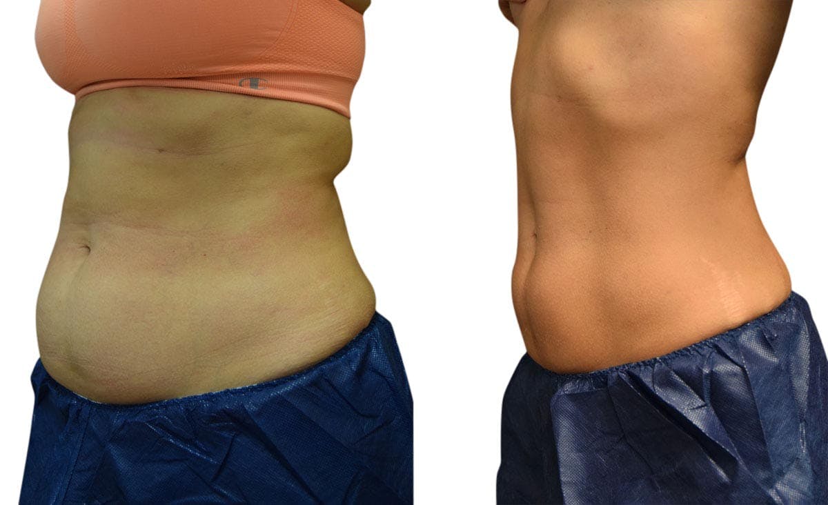 CoolSculpting® Before & After Gallery - Patient 351645 - Image 2