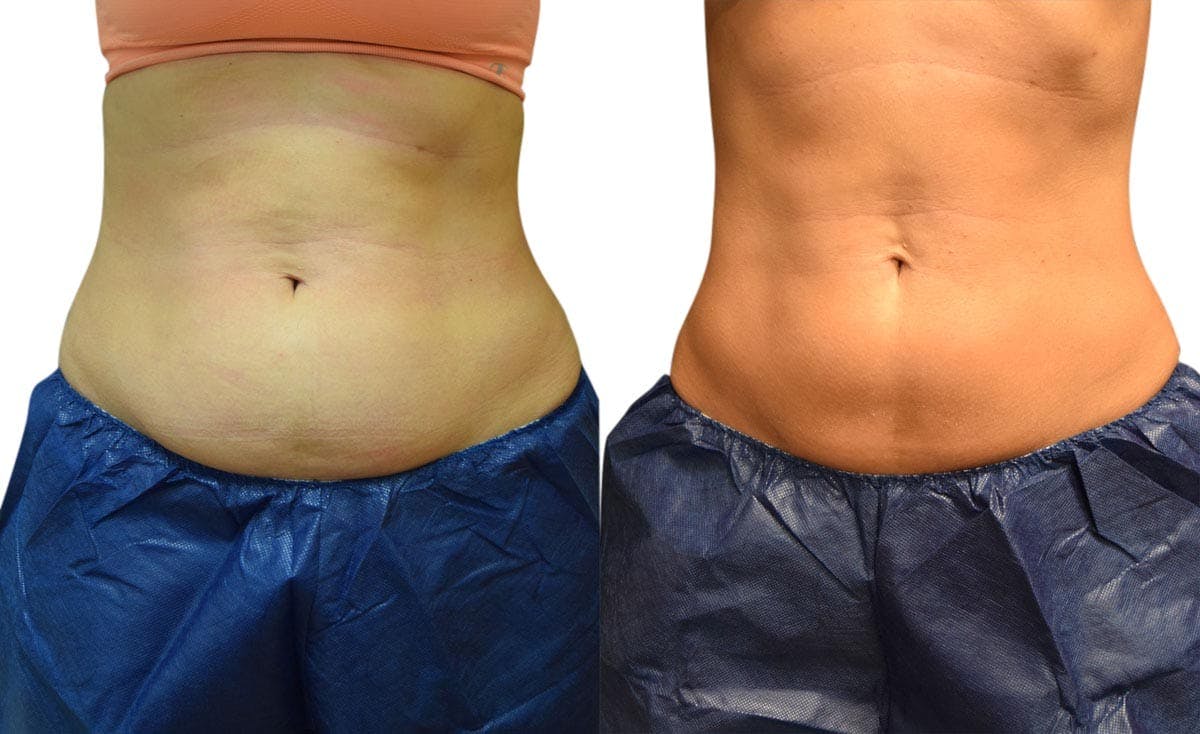 CoolSculpting® Before & After Gallery - Patient 351645 - Image 3