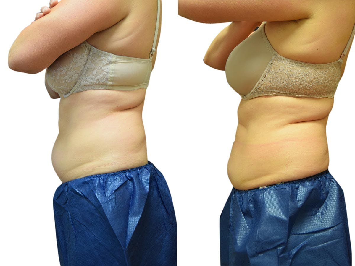 CoolSculpting® Before & After Gallery - Patient 940151 - Image 1