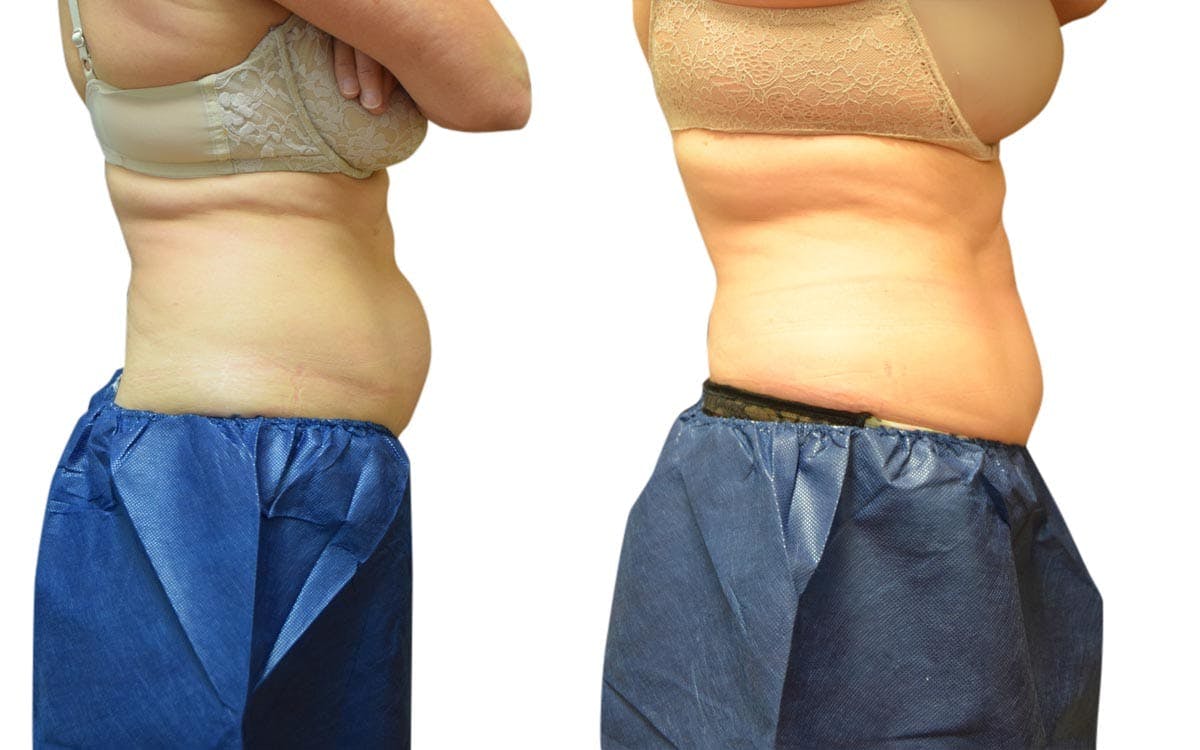 CoolSculpting® Before & After Gallery - Patient 940151 - Image 2