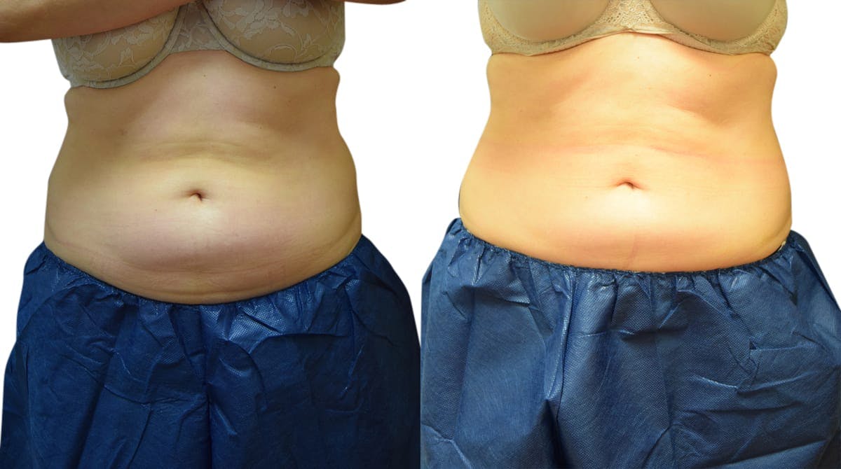 CoolSculpting® Before & After Gallery - Patient 940151 - Image 3