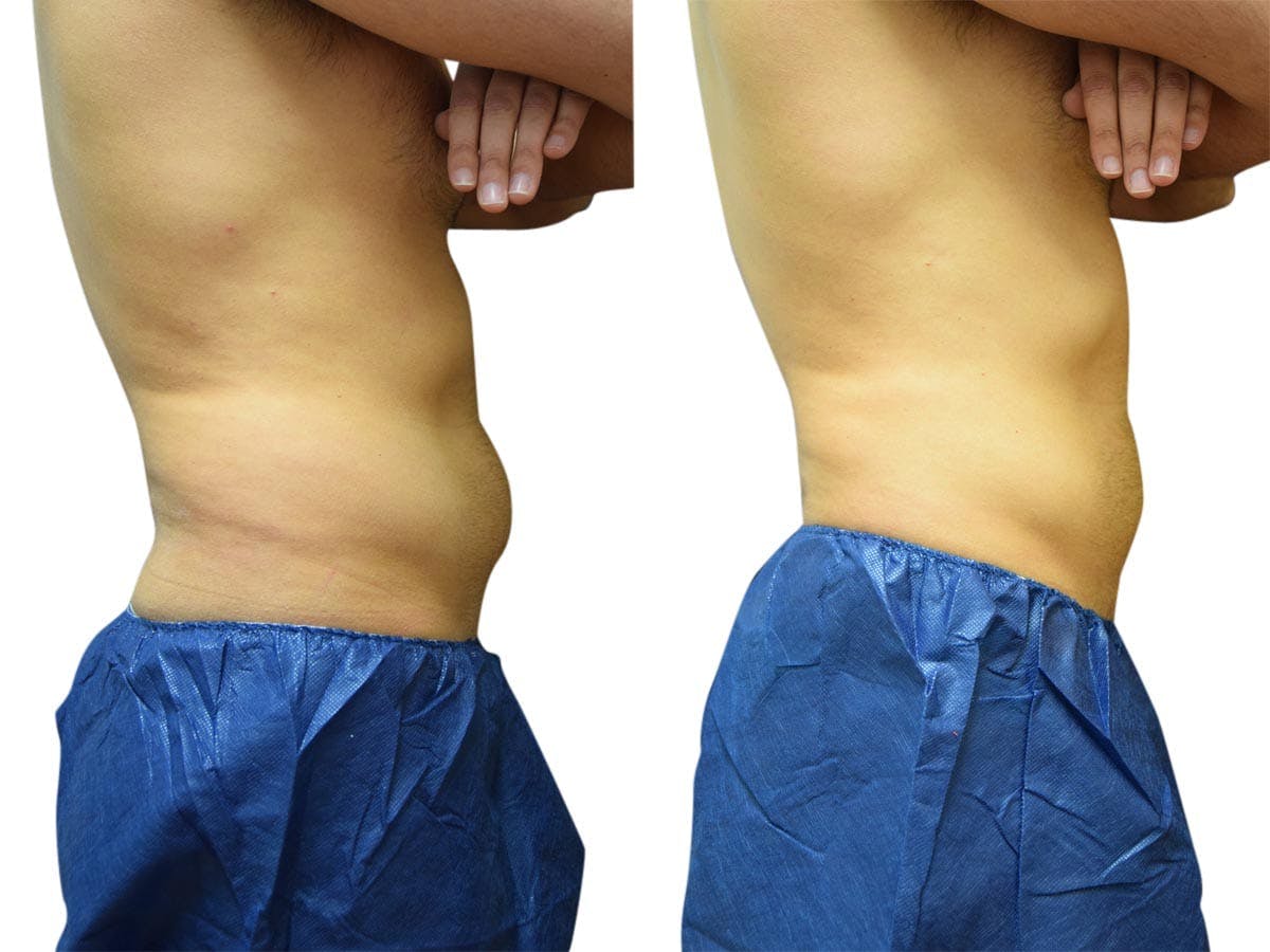 CoolSculpting® Before & After Gallery - Patient 350141 - Image 1