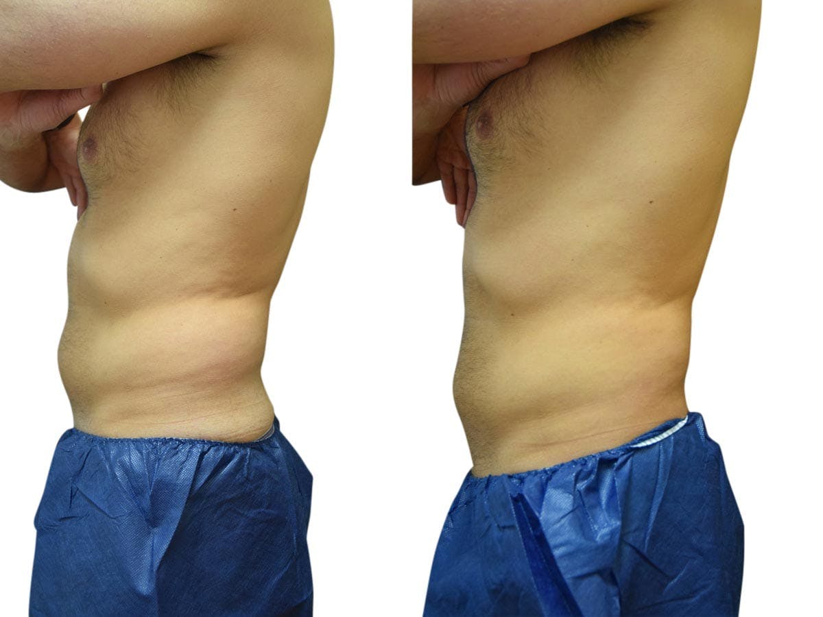 CoolSculpting® Before & After Gallery - Patient 350141 - Image 2