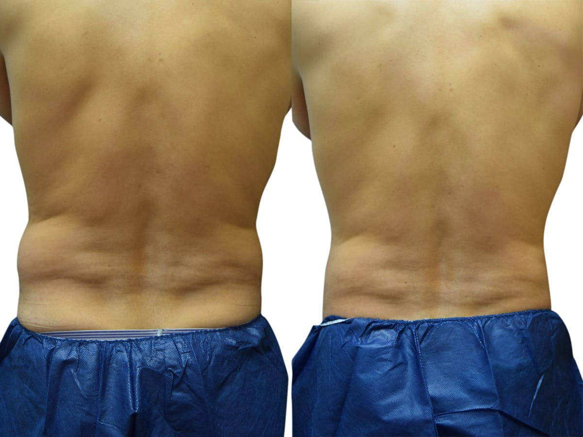 CoolSculpting® Before & After Gallery - Patient 350141 - Image 3