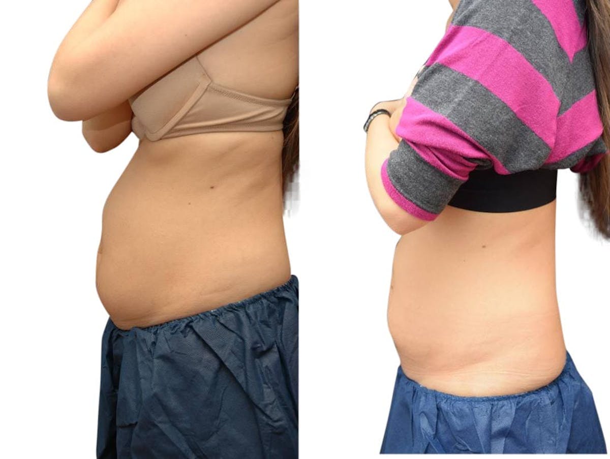CoolSculpting® Before & After Gallery - Patient 296229 - Image 1