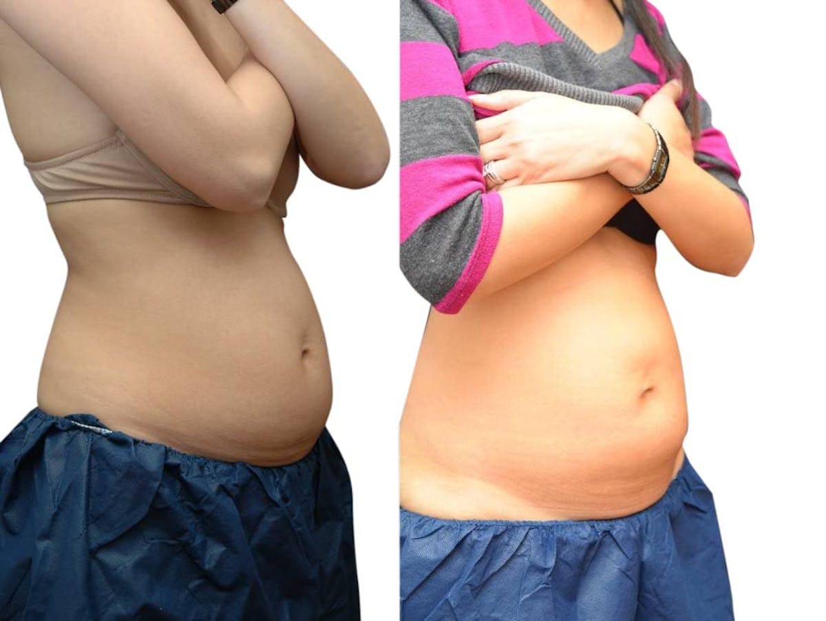 CoolSculpting® Before & After Gallery - Patient 296229 - Image 2