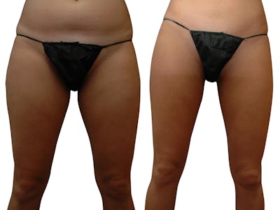 CoolSculpting® Before & After Gallery - Patient 730755 - Image 1