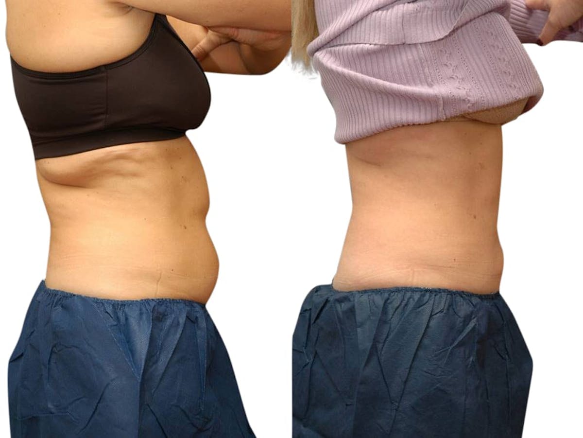 CoolSculpting® Before & After Gallery - Patient 331779 - Image 1