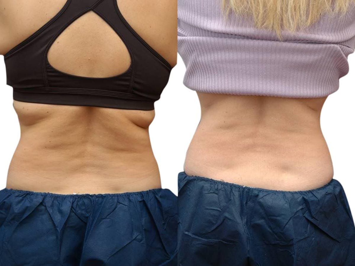 CoolSculpting® Before & After Gallery - Patient 331779 - Image 2