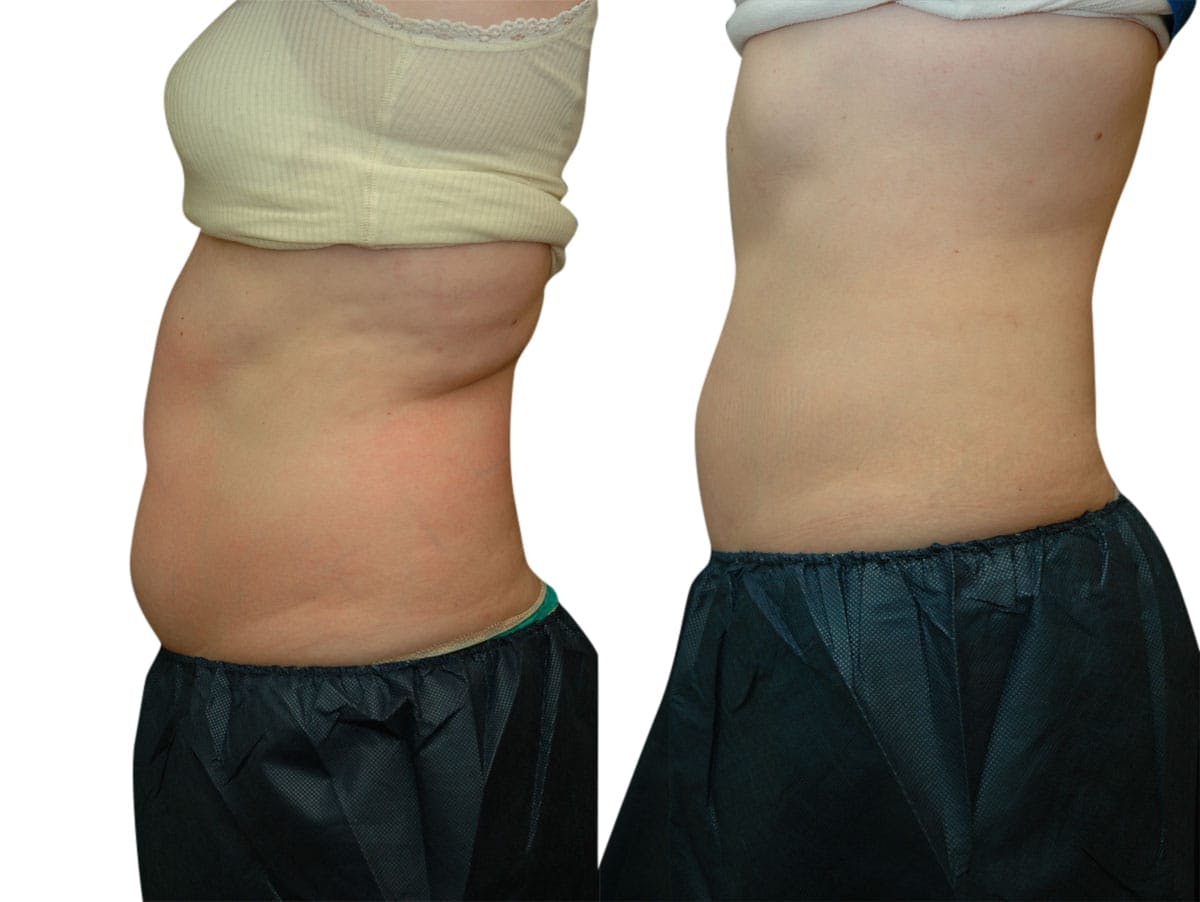 CoolSculpting® Before & After Gallery - Patient 250161 - Image 1