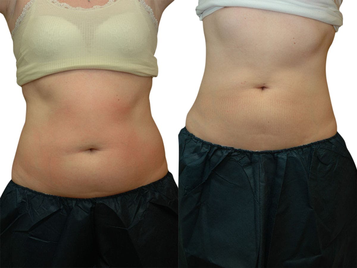CoolSculpting® Before & After Gallery - Patient 250161 - Image 2