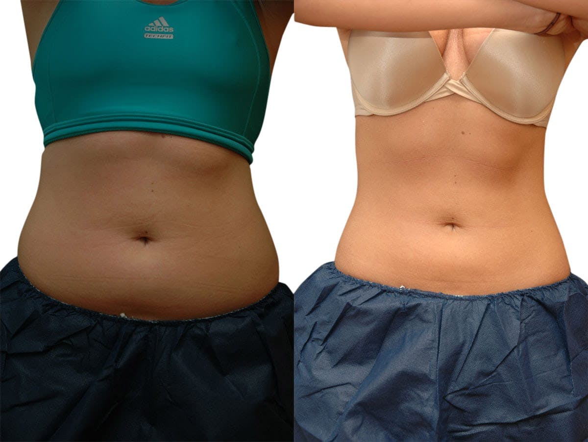 CoolSculpting® Before & After Gallery - Patient 870236 - Image 1