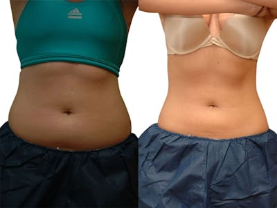 CoolSculpting® Before & After Gallery - Patient 870236 - Image 1