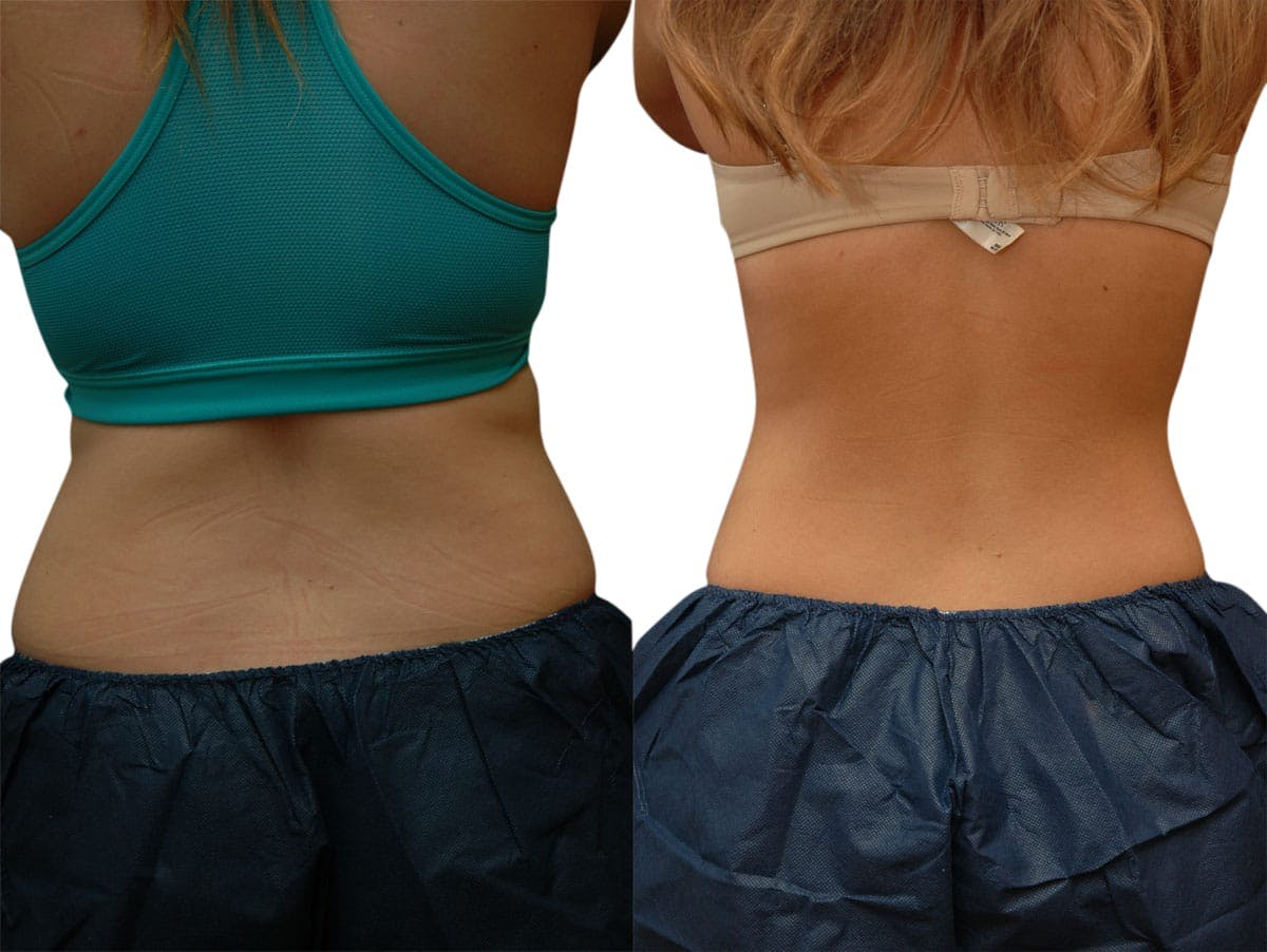 CoolSculpting® Before & After Gallery - Patient 870236 - Image 2