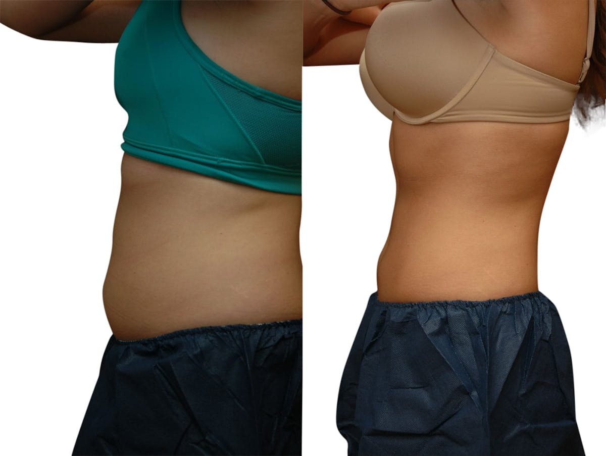 CoolSculpting® Before & After Gallery - Patient 870236 - Image 3