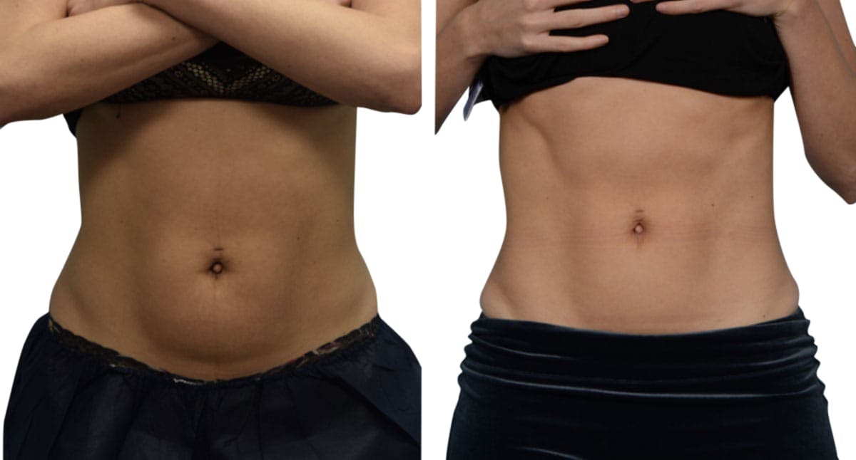 CoolSculpting® Before & After Gallery - Patient 295595 - Image 1
