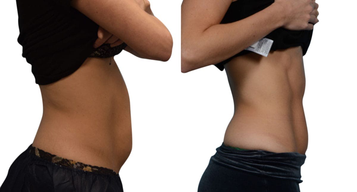 CoolSculpting® Before & After Gallery - Patient 295595 - Image 2