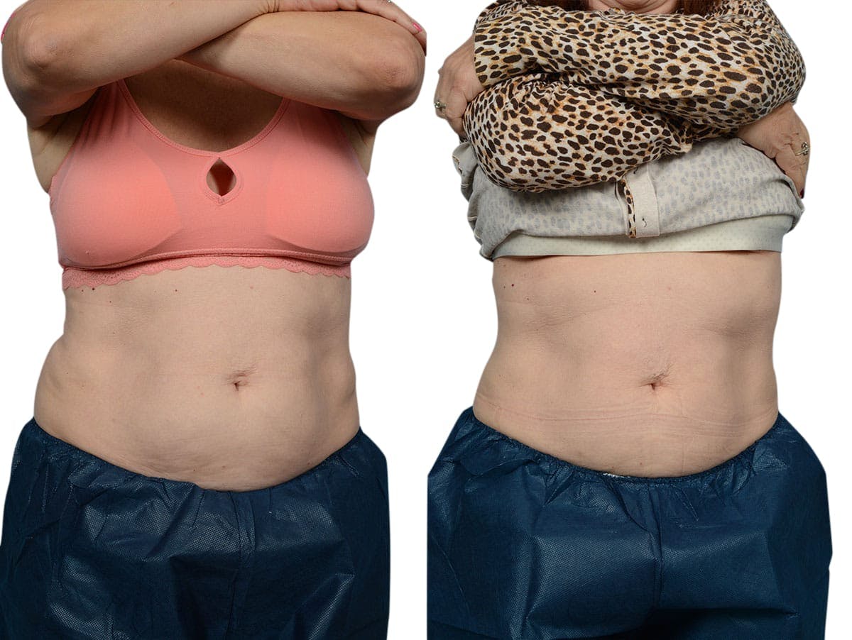 CoolSculpting® Before & After Gallery - Patient 240205 - Image 1