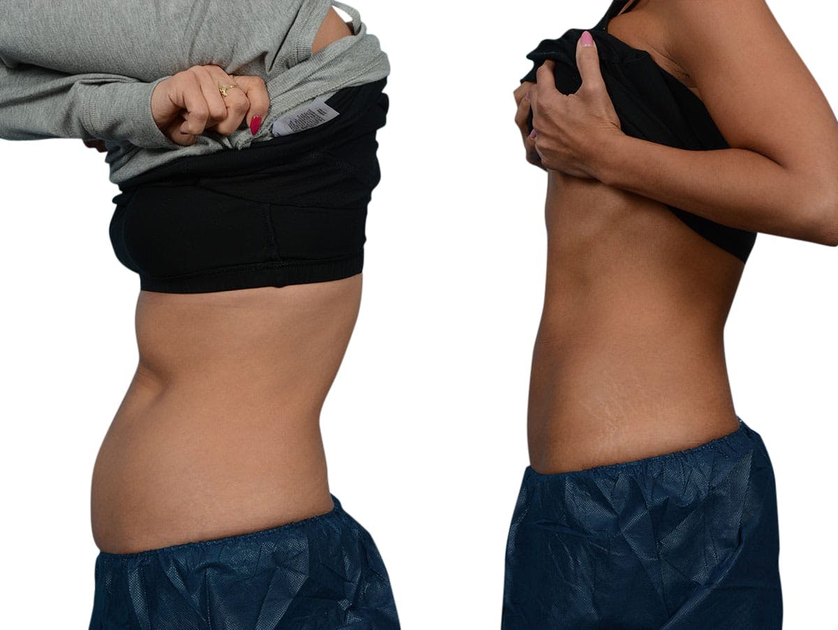 CoolSculpting® Before & After Gallery - Patient 107260 - Image 1