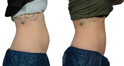 CoolSculpting® Before & After Gallery - Patient 345016 - Image 1