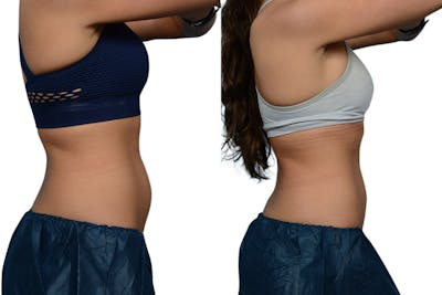 CoolSculpting® Before & After Gallery - Patient 507990 - Image 1