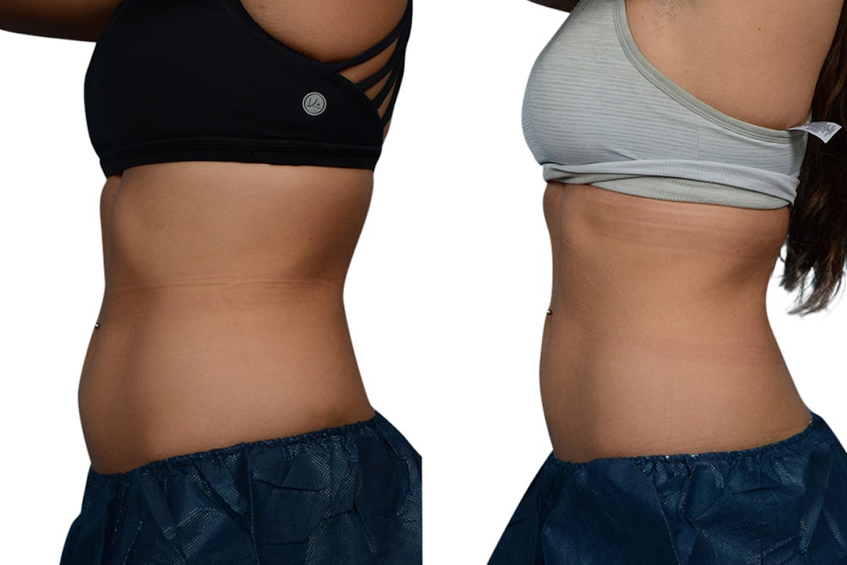 CoolSculpting® Before & After Gallery - Patient 507990 - Image 2
