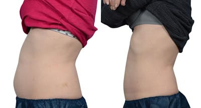 CoolSculpting® Before & After Gallery - Patient 217351 - Image 1