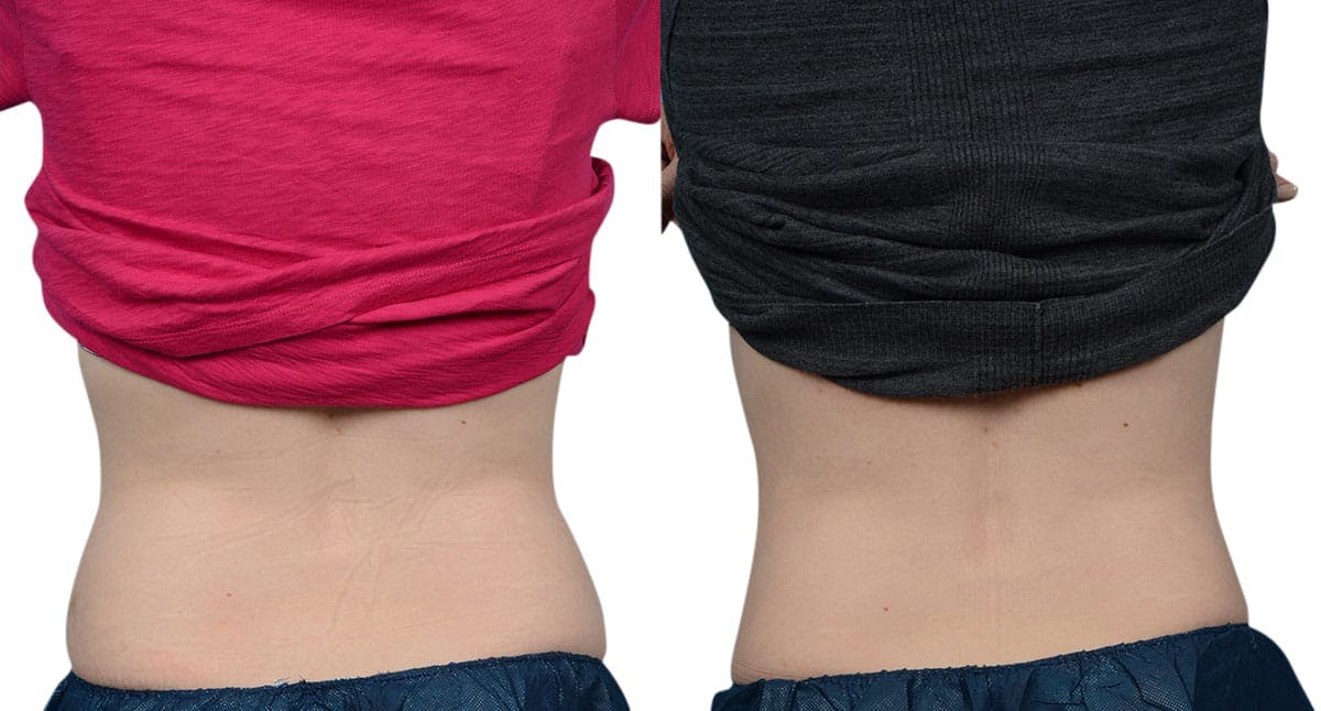 CoolSculpting® Before & After Gallery - Patient 217351 - Image 2