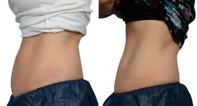 CoolSculpting® Before & After Gallery - Patient 395582 - Image 1