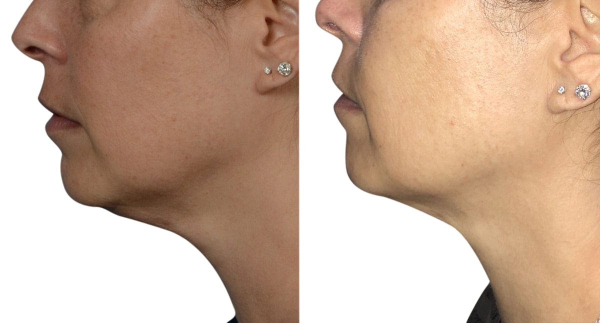 CoolSculpting® Before & After Gallery - Patient 212157 - Image 1